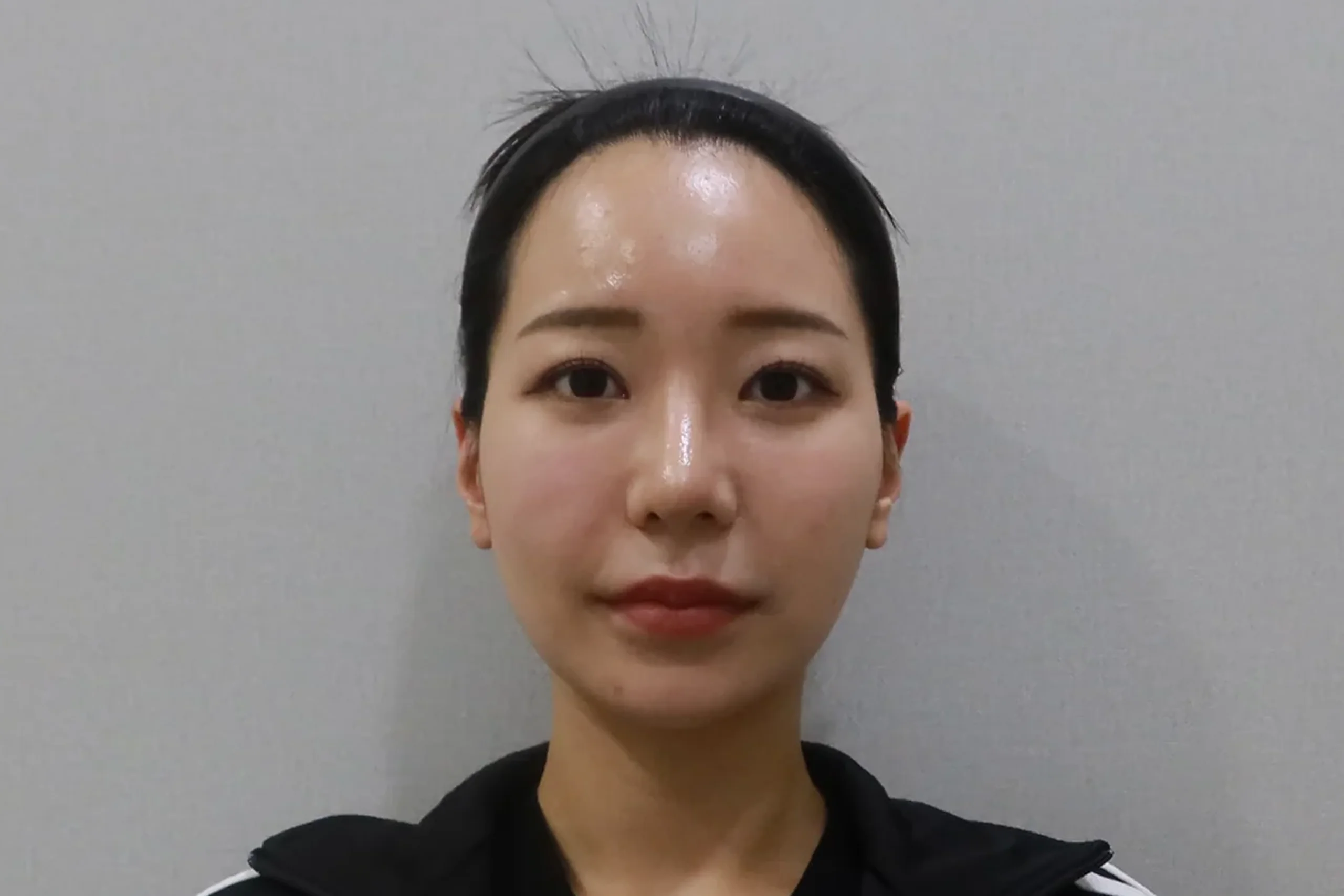 唇部填充术后正面图