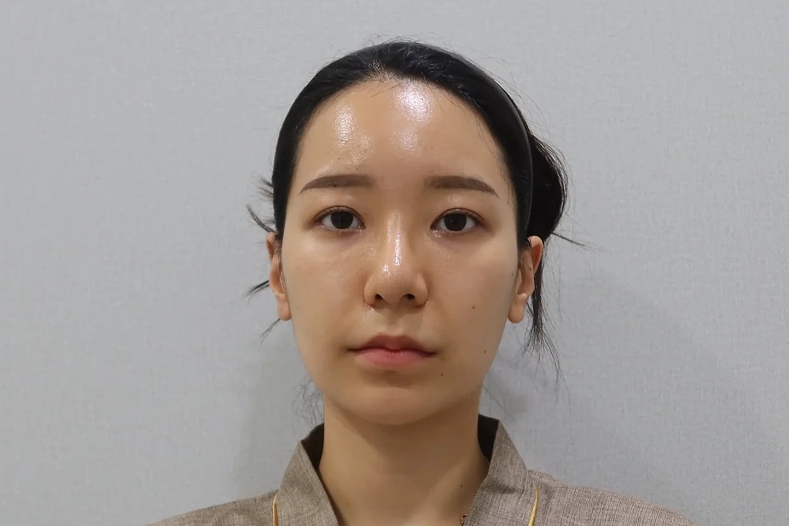 唇部填充治疗前的正面图