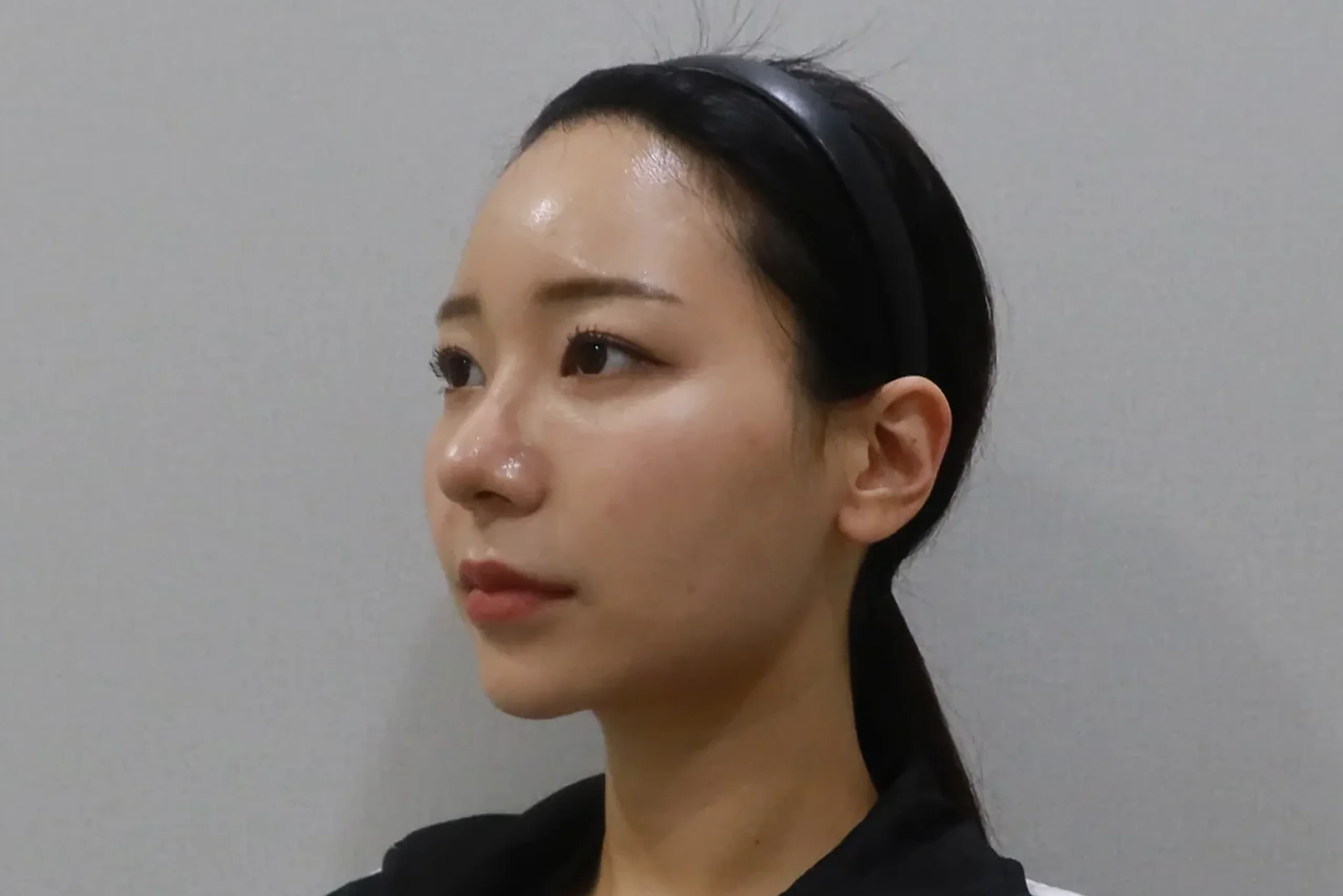 唇部填充治疗后的半侧视图