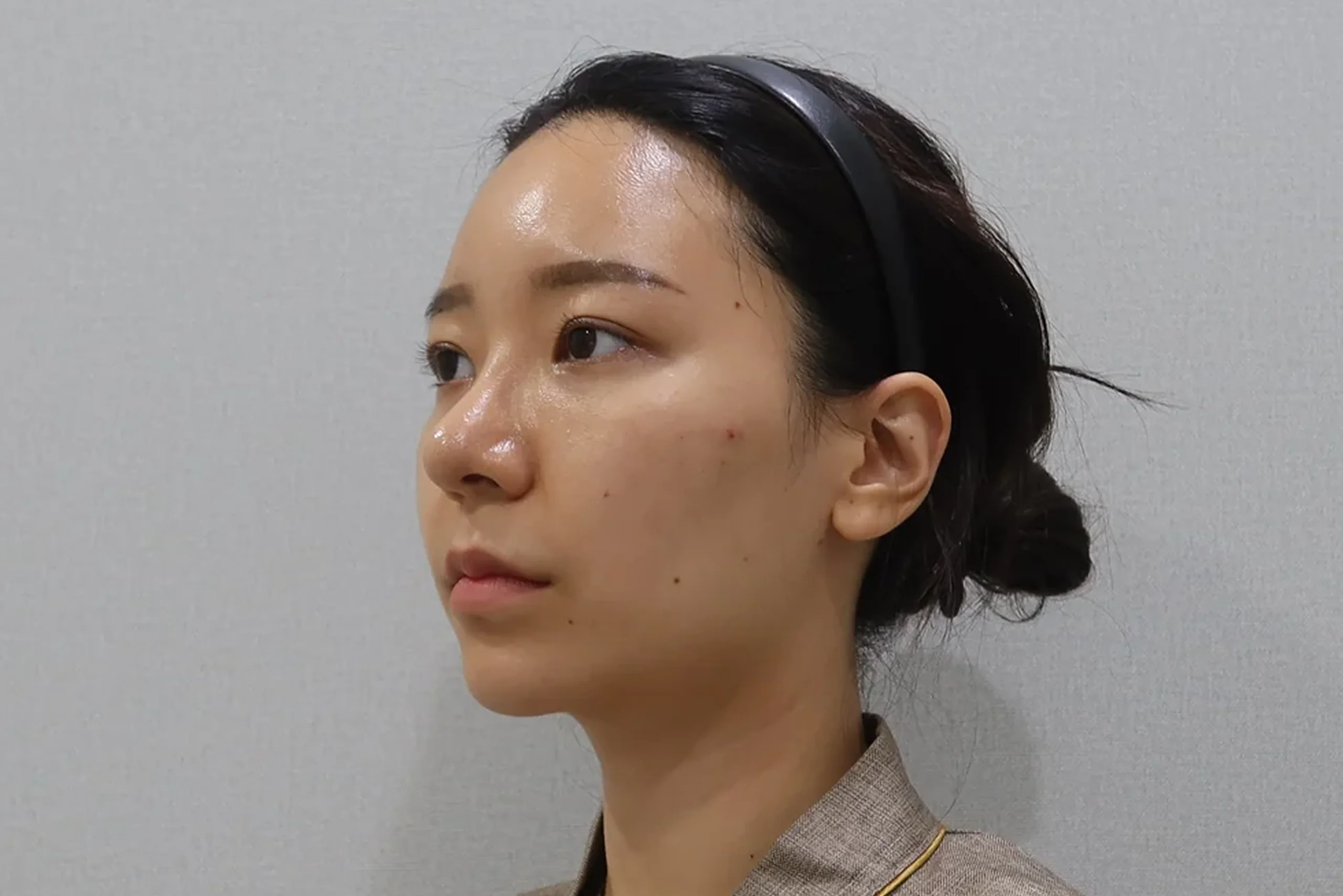 唇部填充治疗前的半侧视图