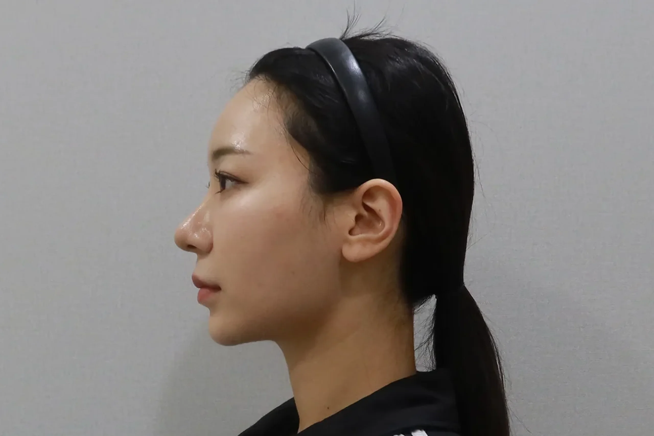 唇部填充治疗后的侧视图