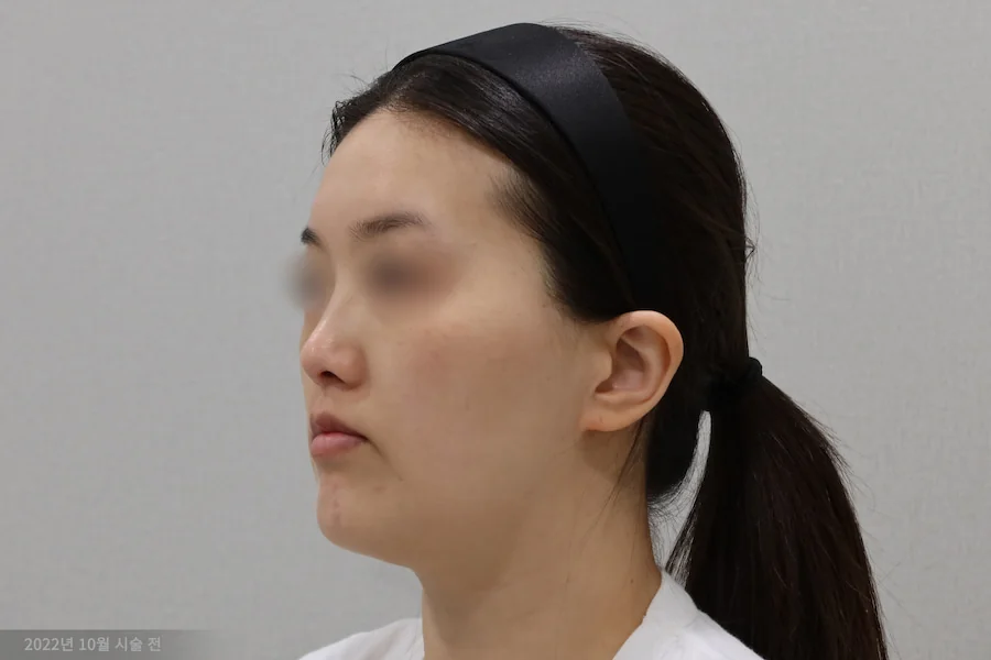 钛激光治疗前的半侧病例