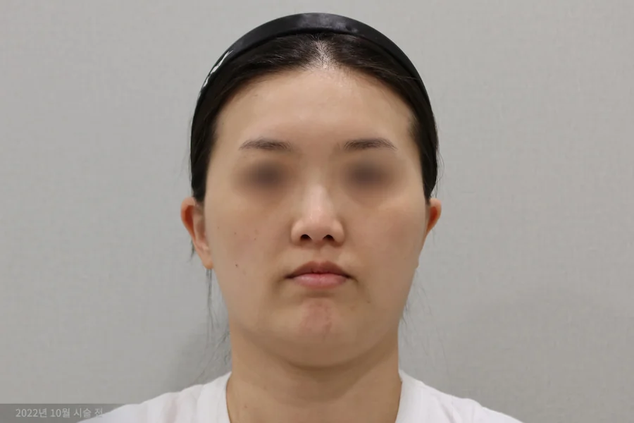 钛激光治疗前的正面图 1