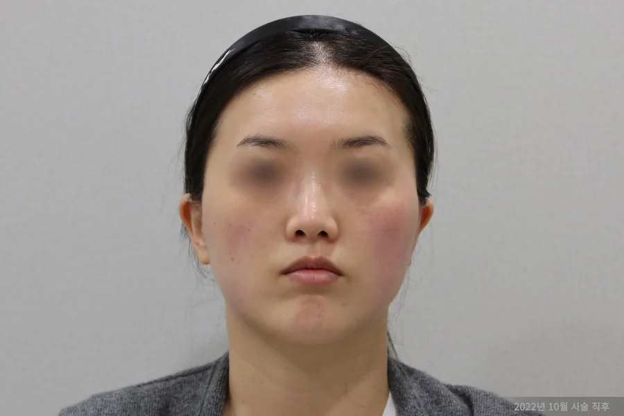 钛激光治疗后的额部变化 1