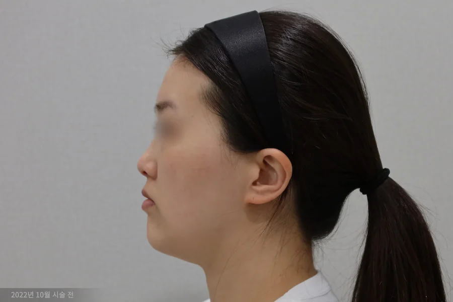 Dr.Eraser钛激光治疗前的侧视图