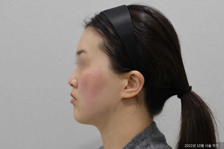 擦除圈钛激光治疗后的侧面变化