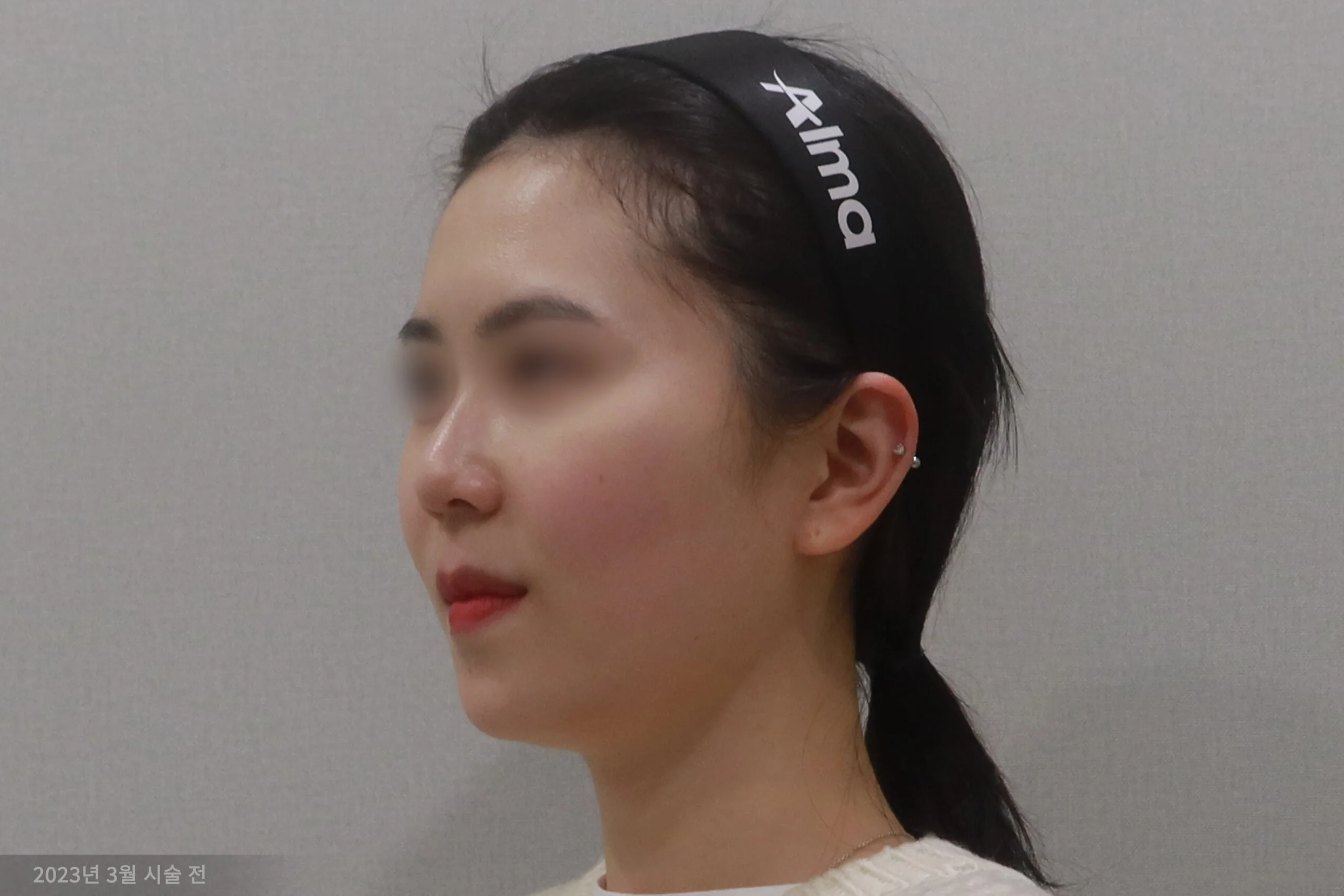 拉皮手术前的半侧病例