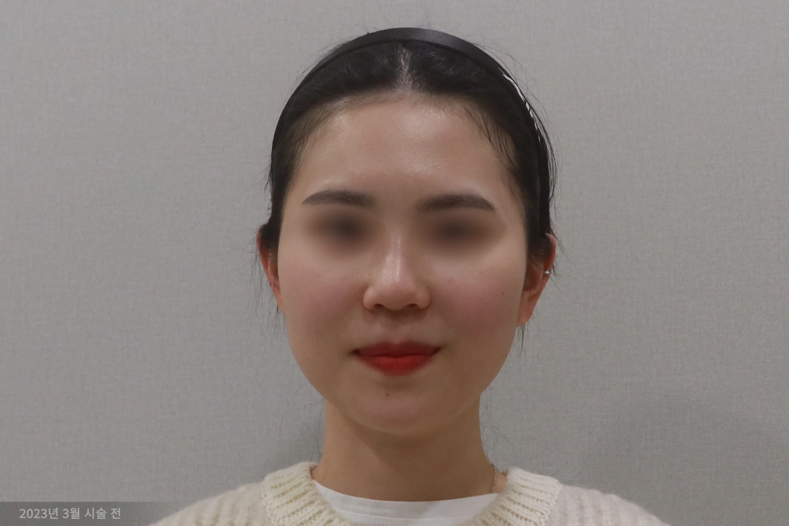 拉皮手术前的正面示例