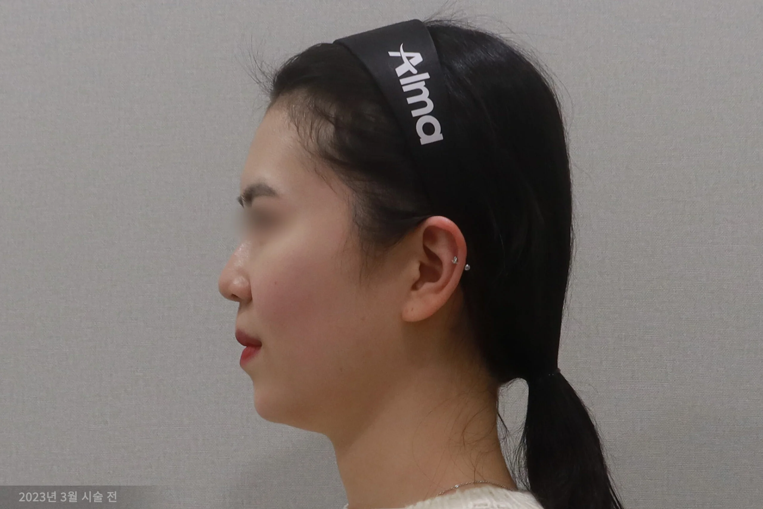 拉皮手术前的侧视图