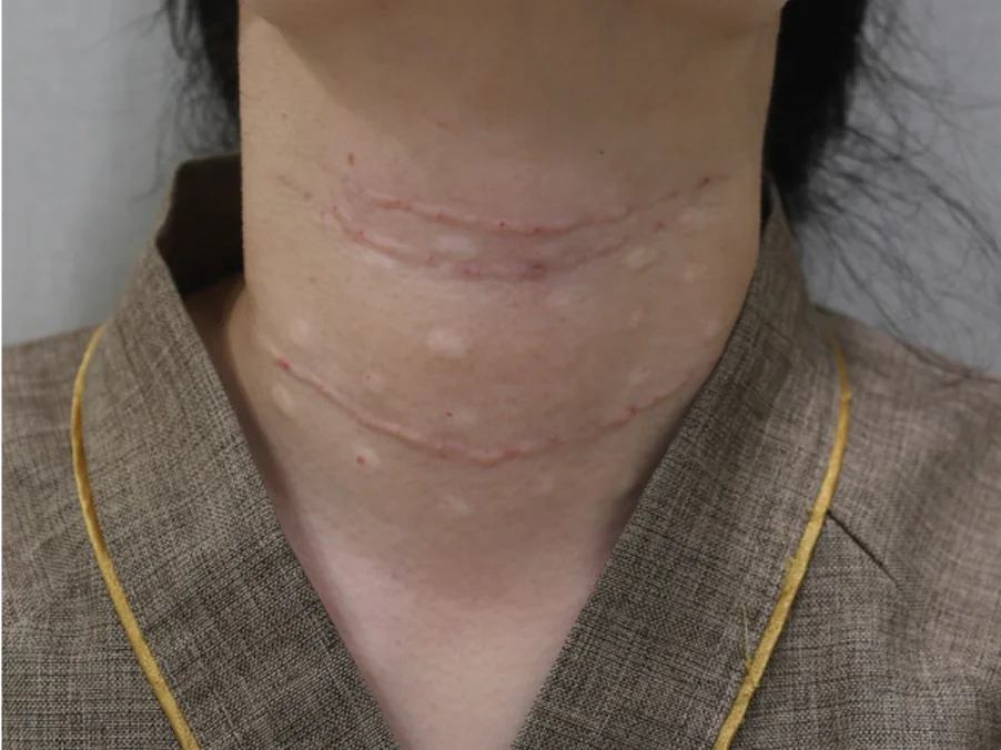 Necklisset 颈部除皱治疗后的案例 2