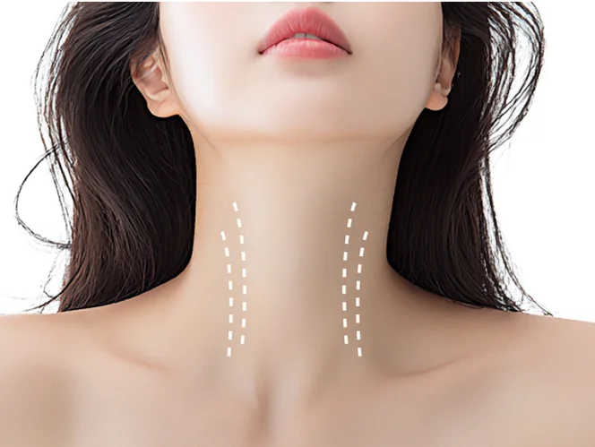 可通过 Necklisset 改善的第 3 类颈部皱纹案例