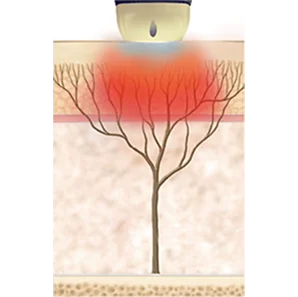 SHR 模式--收缩毛孔，改善肤质，减少细纹