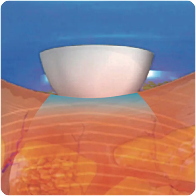 使用 TuneFace 冰接触冷却技术进行无痛治疗