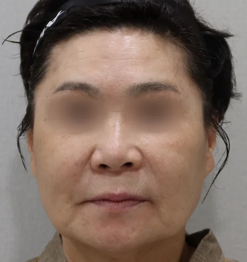 钛激光治疗前的正面图 2