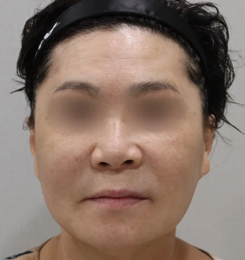 钛激光治疗后的额部变化 2