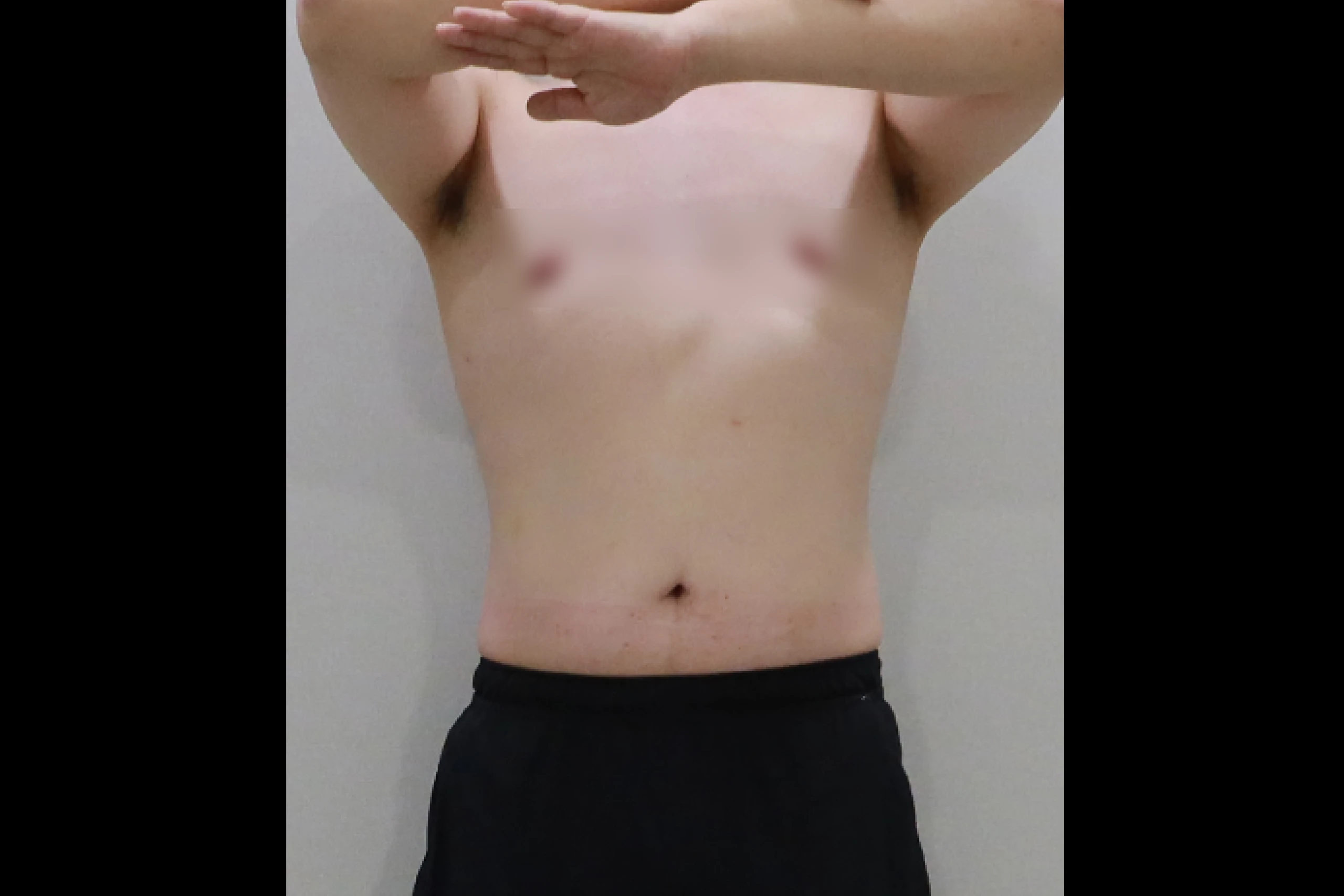 全身吸脂手术后的全身效果