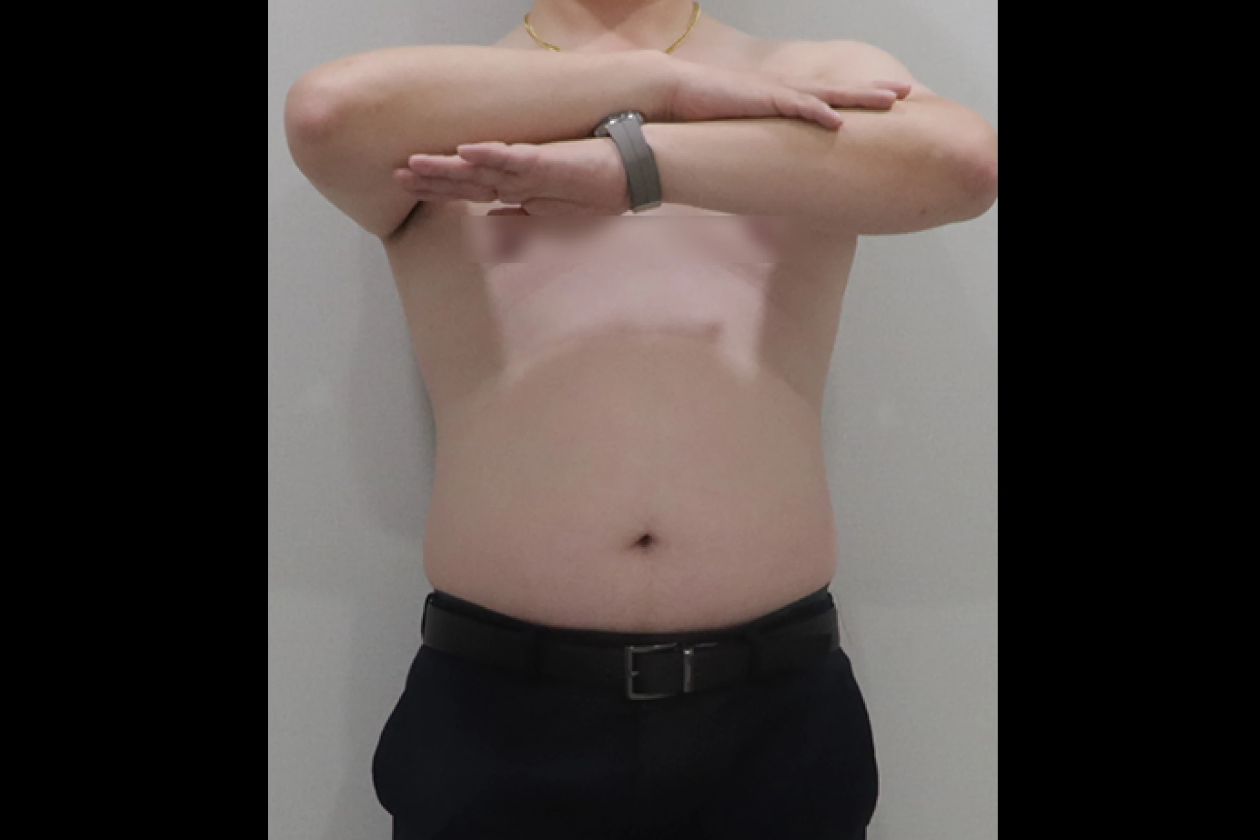 全身瘦身手术前的全身照片