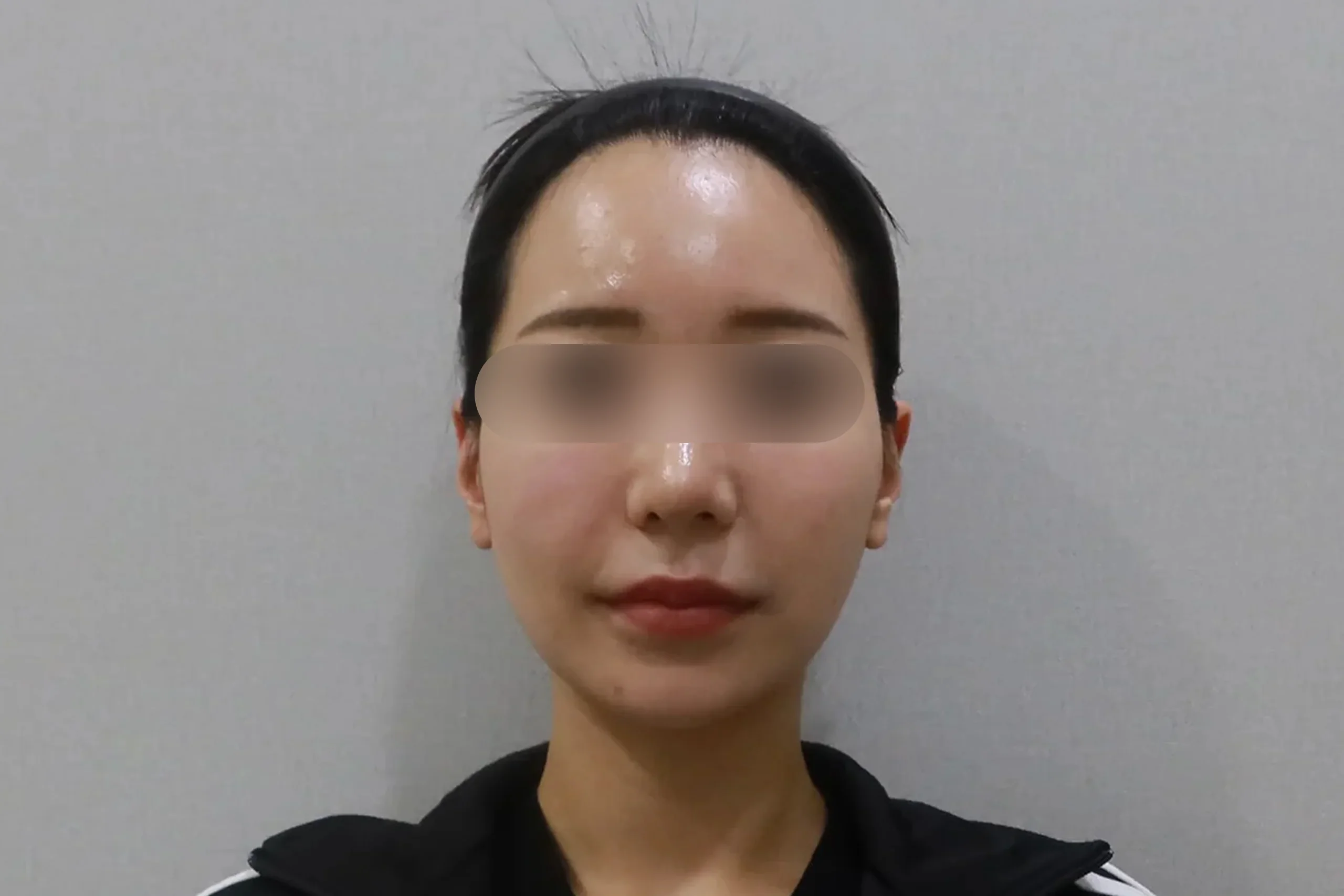 Eraser Clinic 唇部填充前正面图