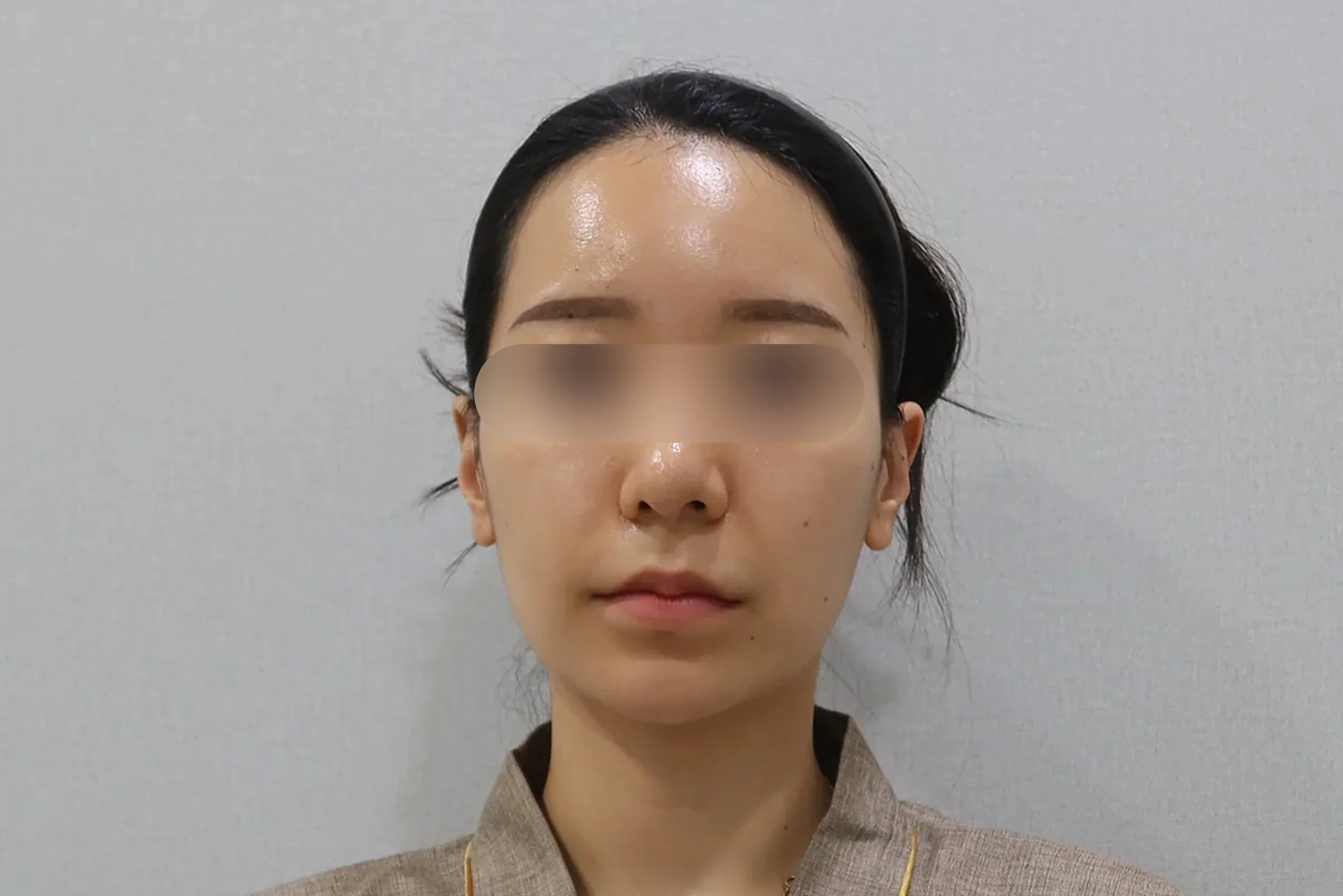 Dr.Eraser唇部填充术后正面图