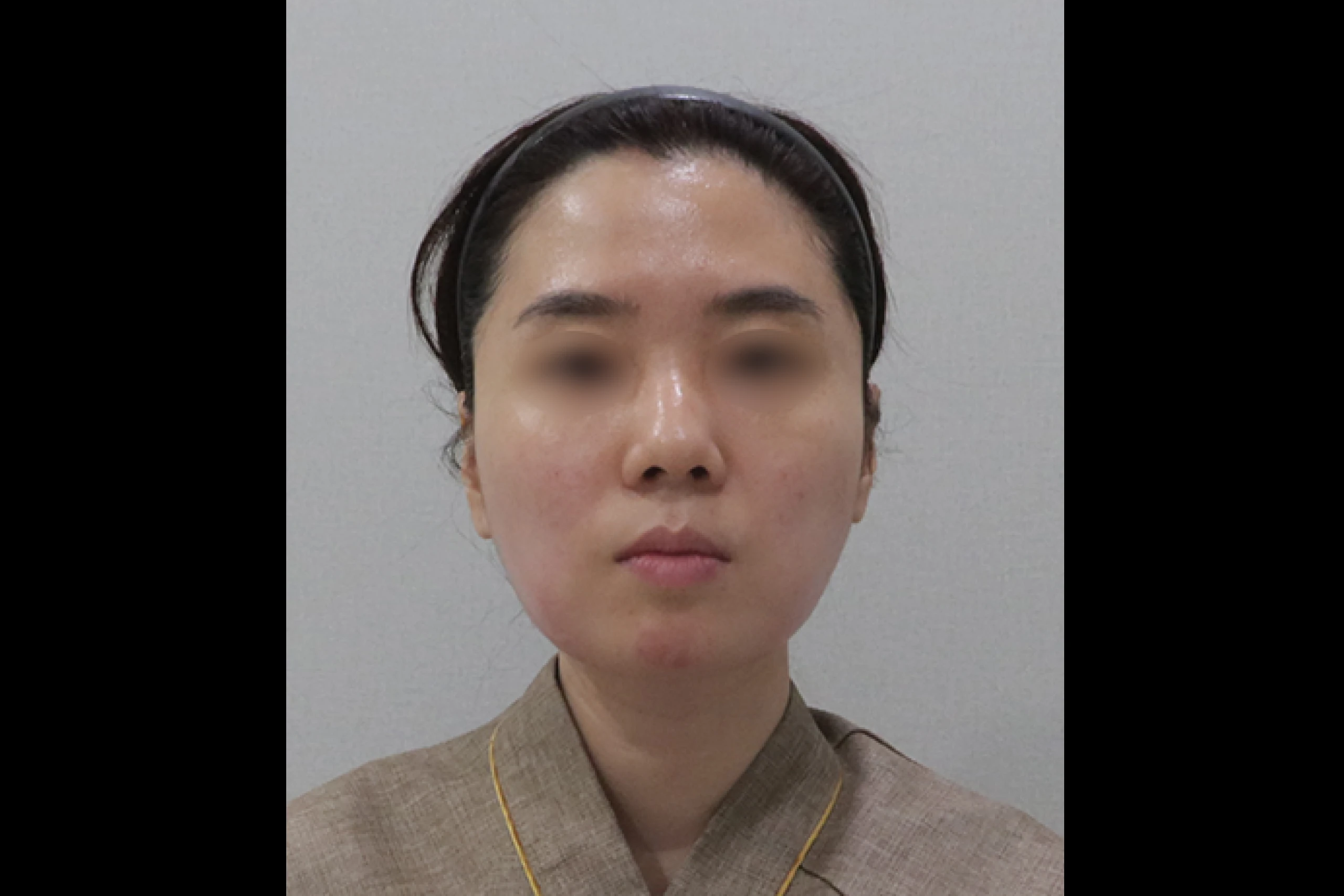 经过 TuneLiner TuneFace 处理后，V 字形前脸外观得到改善