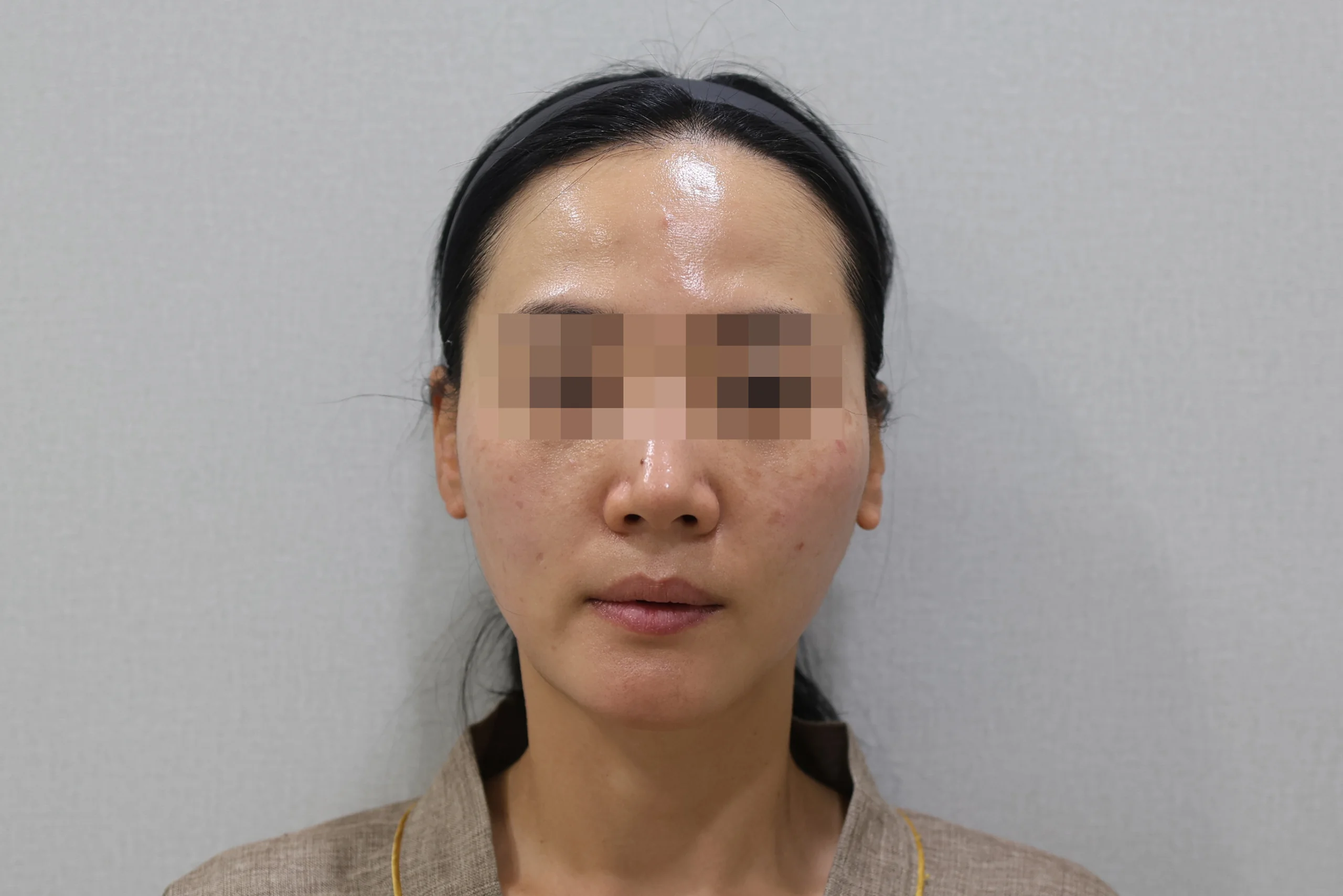 XERF 治疗后的正面图 1