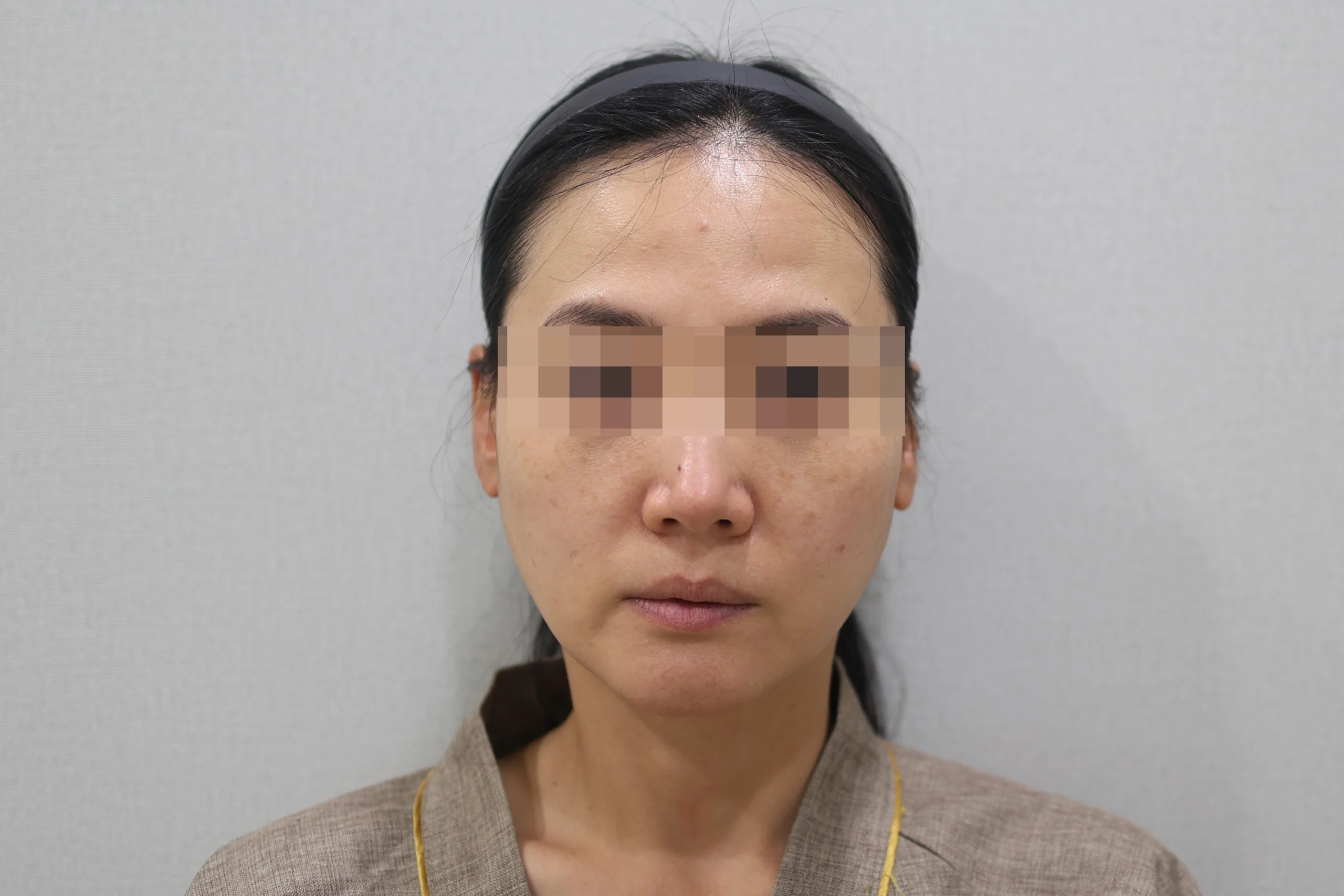 1 张治疗前的正面照片