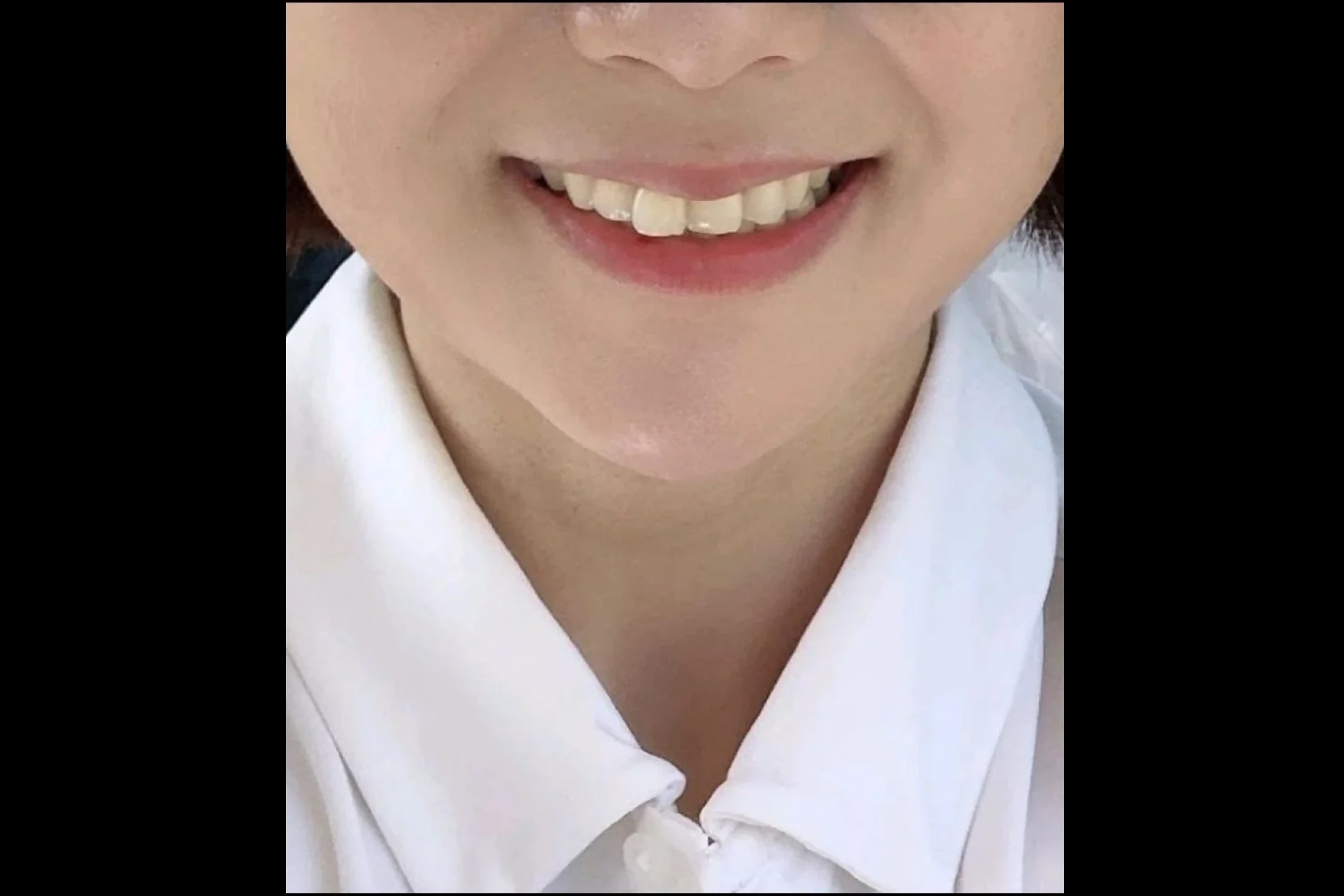 EraserCircle 丰唇后填充术