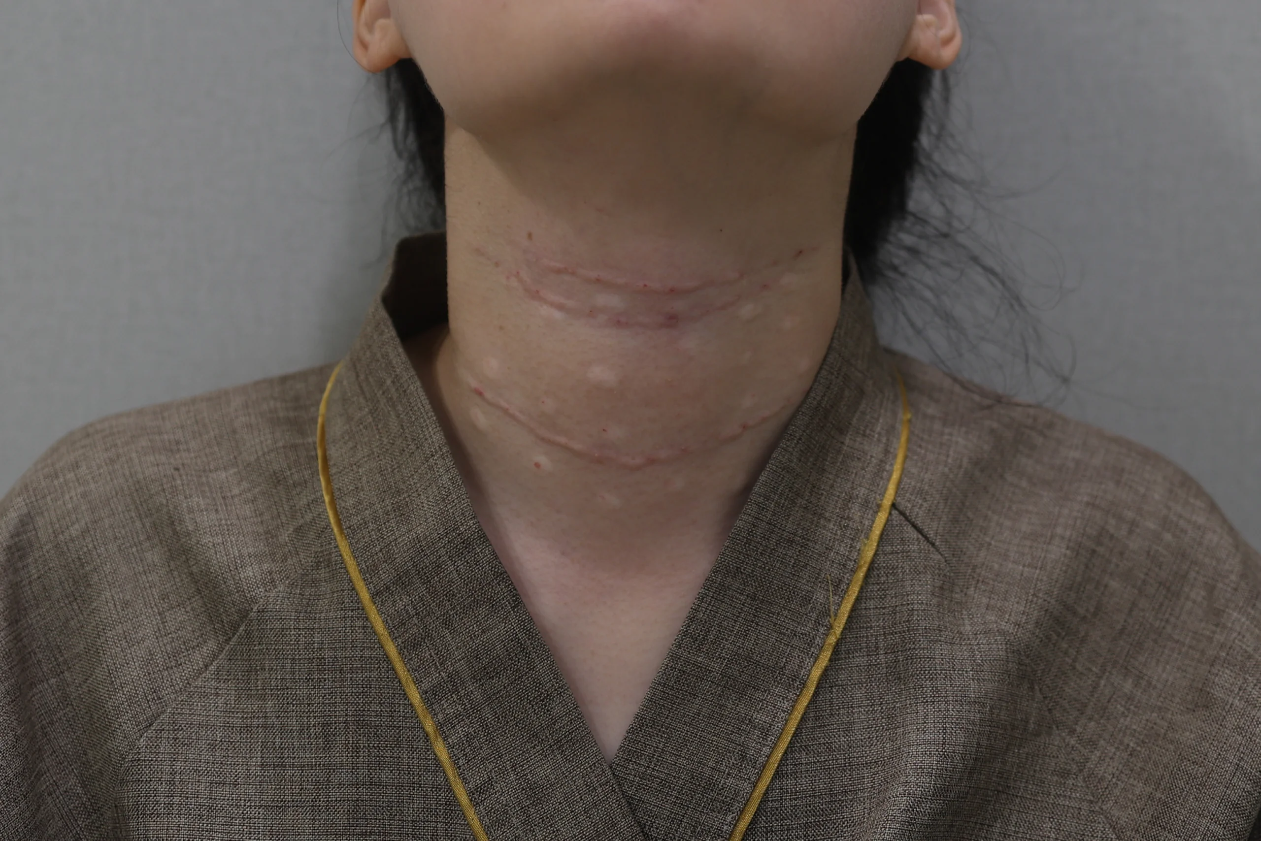 Necklisset 颈部除皱器 在您的病例中添加术前照片