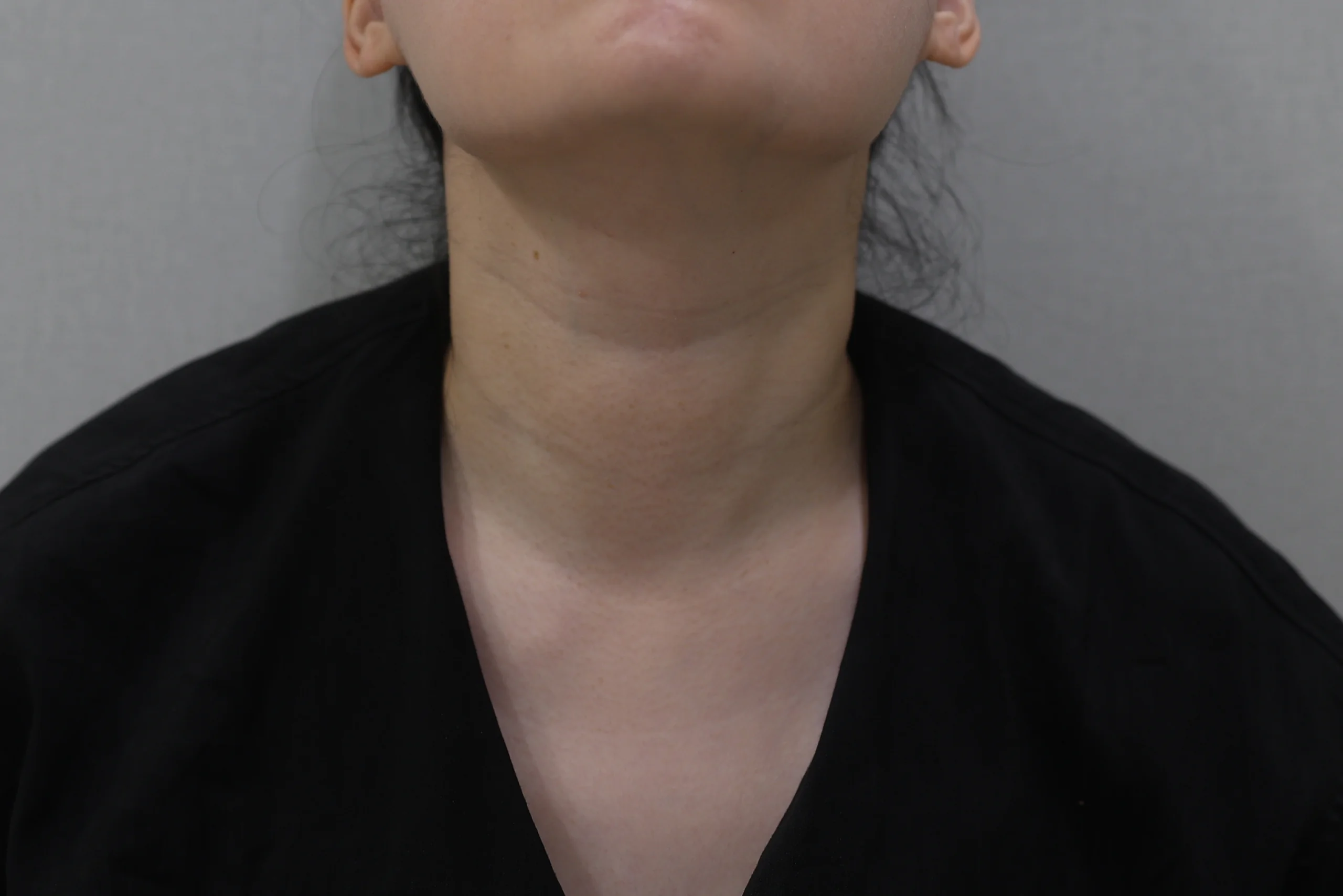 添加 Necklisset 颈部除皱治疗后的照片 案例