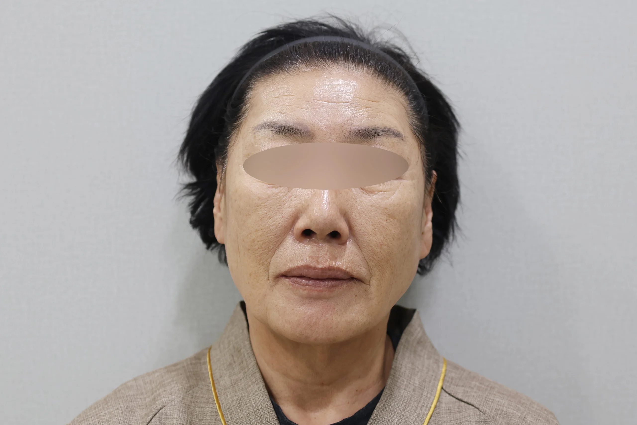 XERF 治疗后的正面图 2