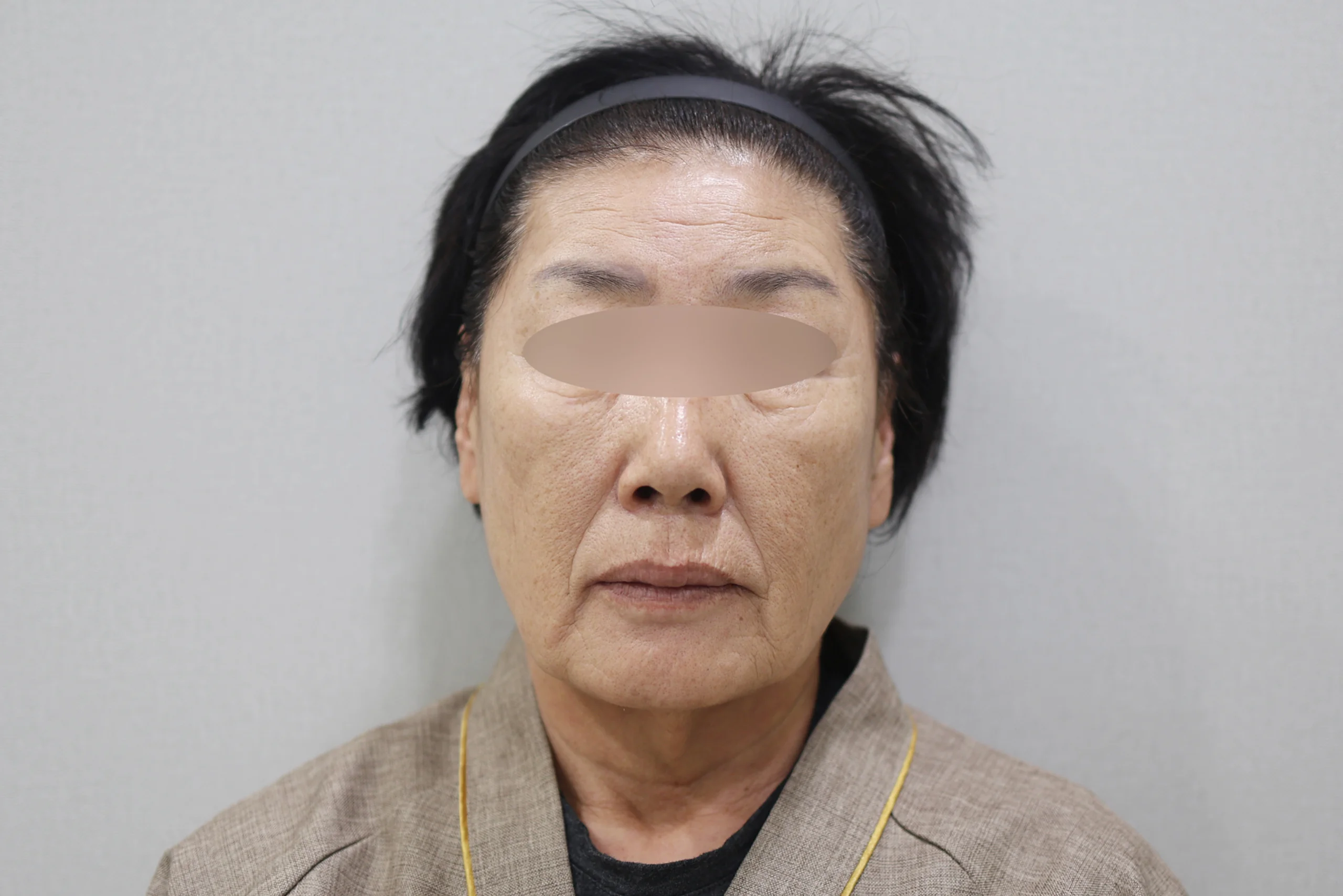 XERF 治疗前的正面图 2