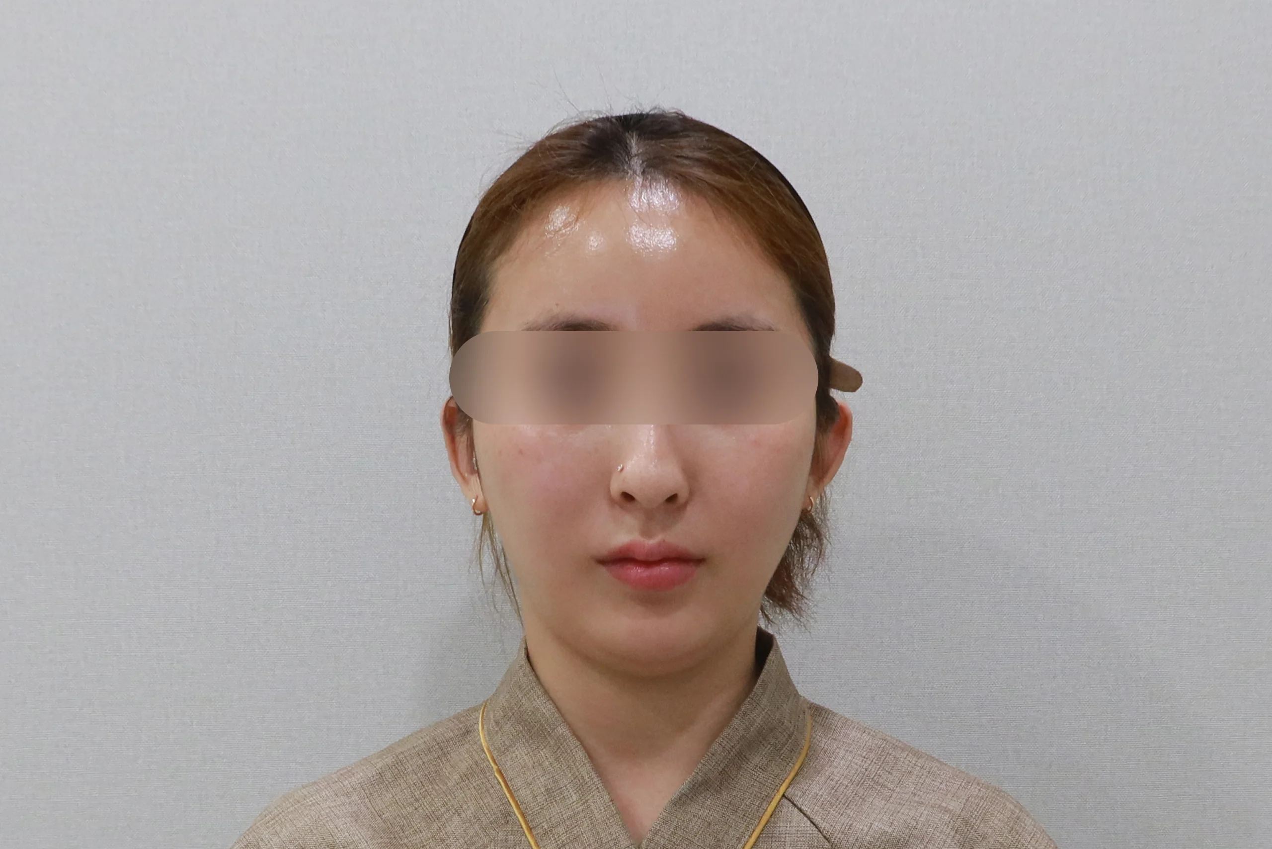 面部除皱注射后的正面图 3