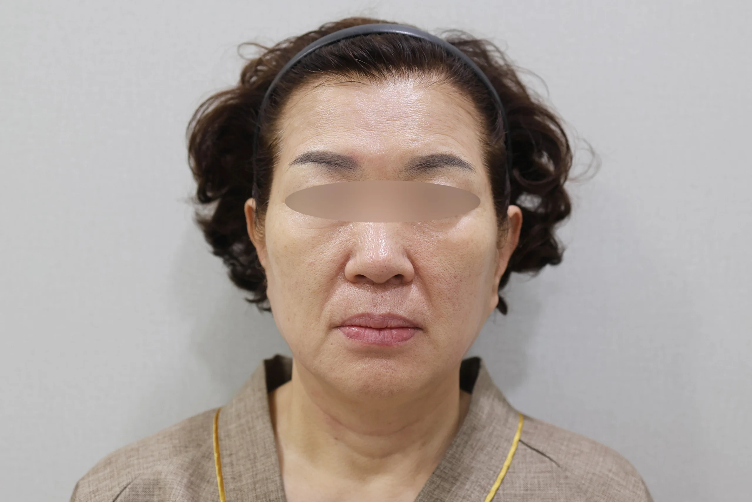 XERF 治疗后的正面图 3