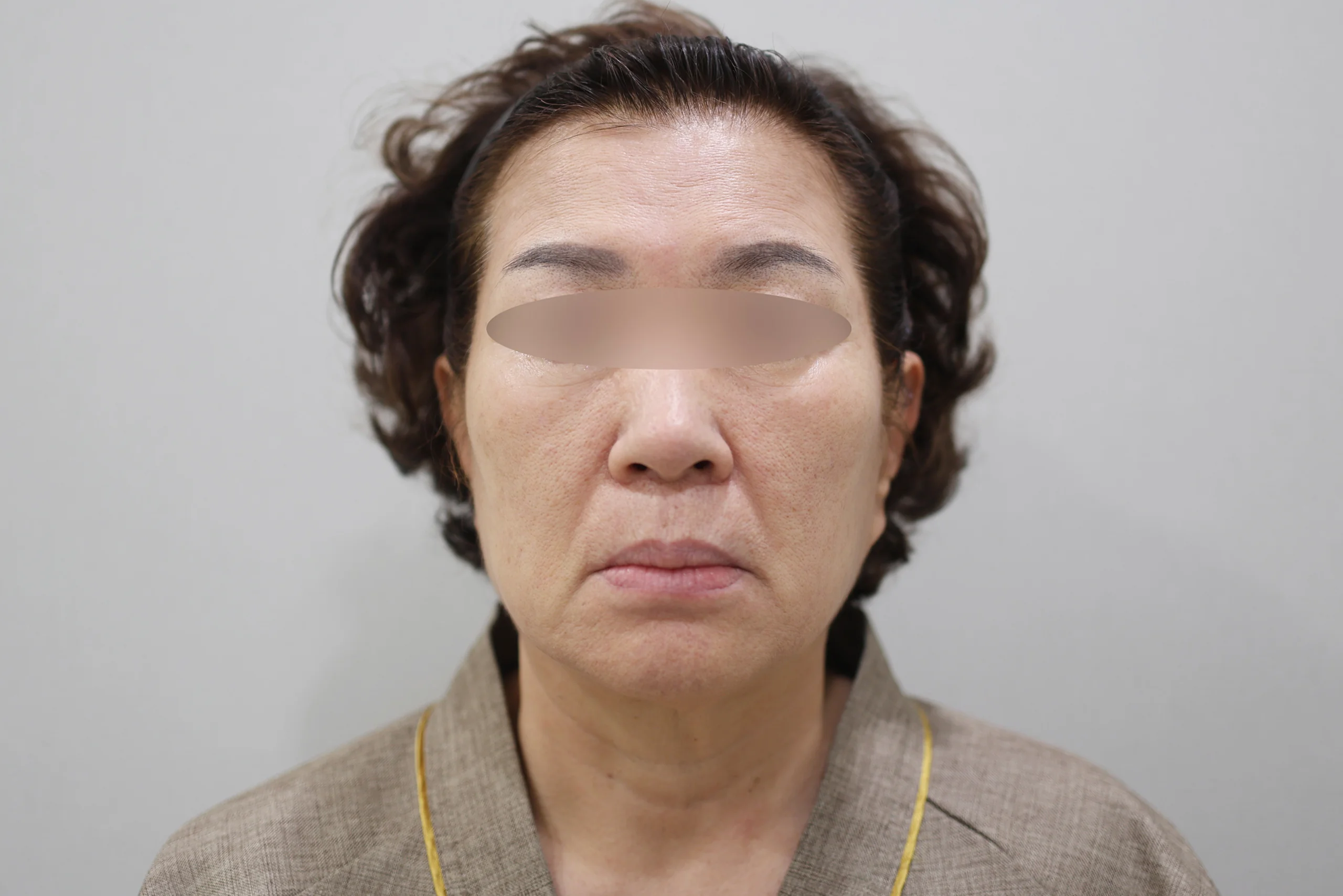 XERF 治疗前的正面图 3