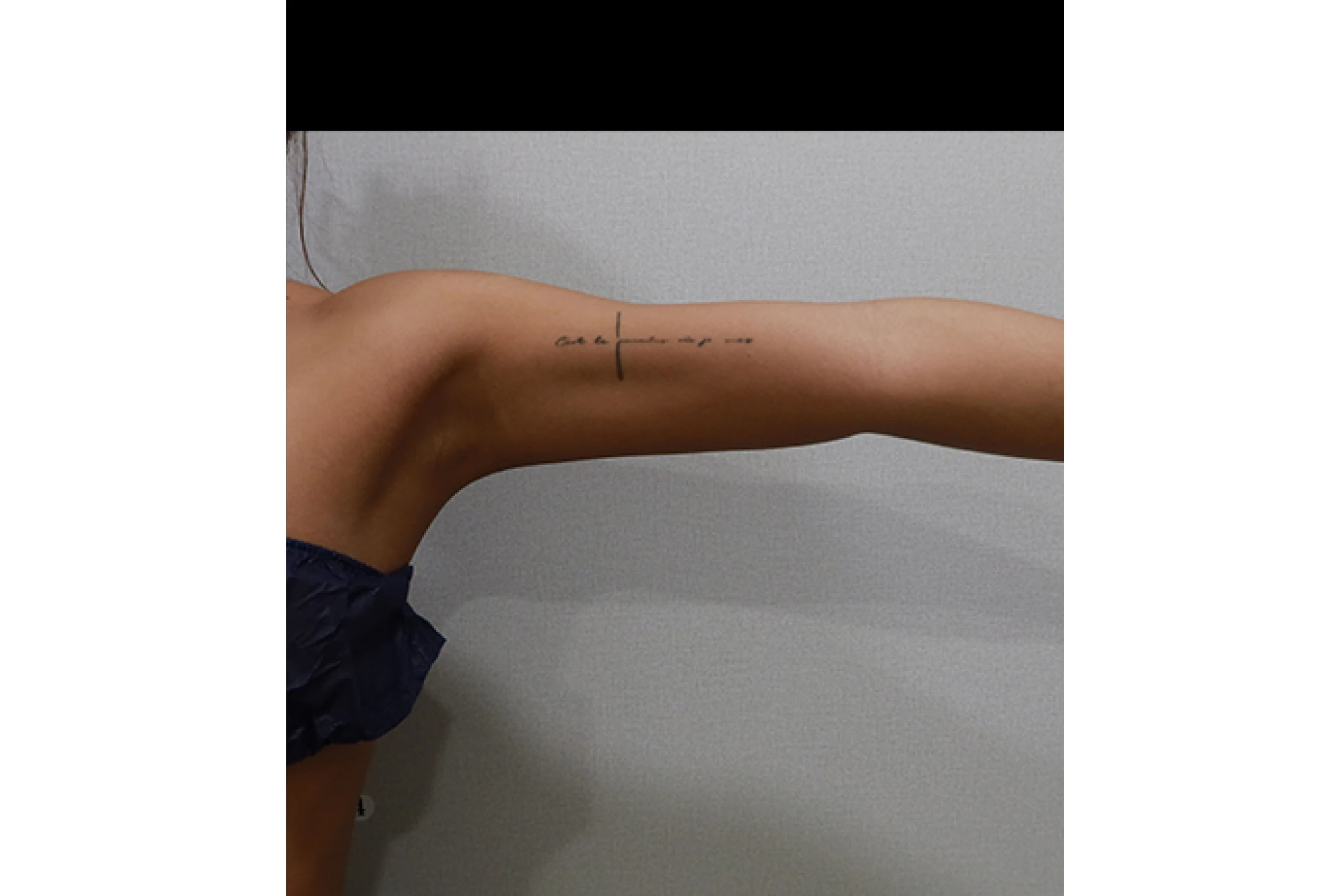 人体钛激光治疗后的侧视图 04