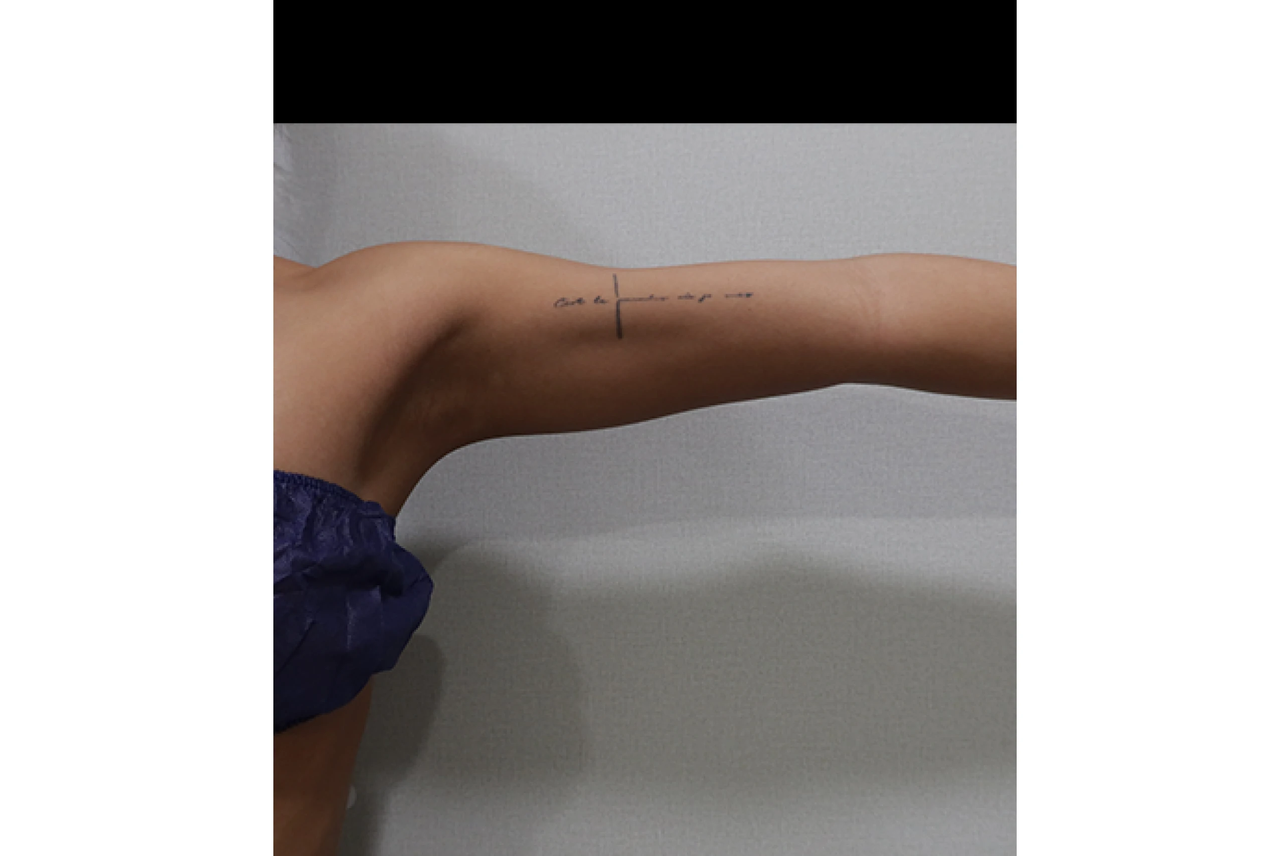 人体钛激光治疗前侧视图 04