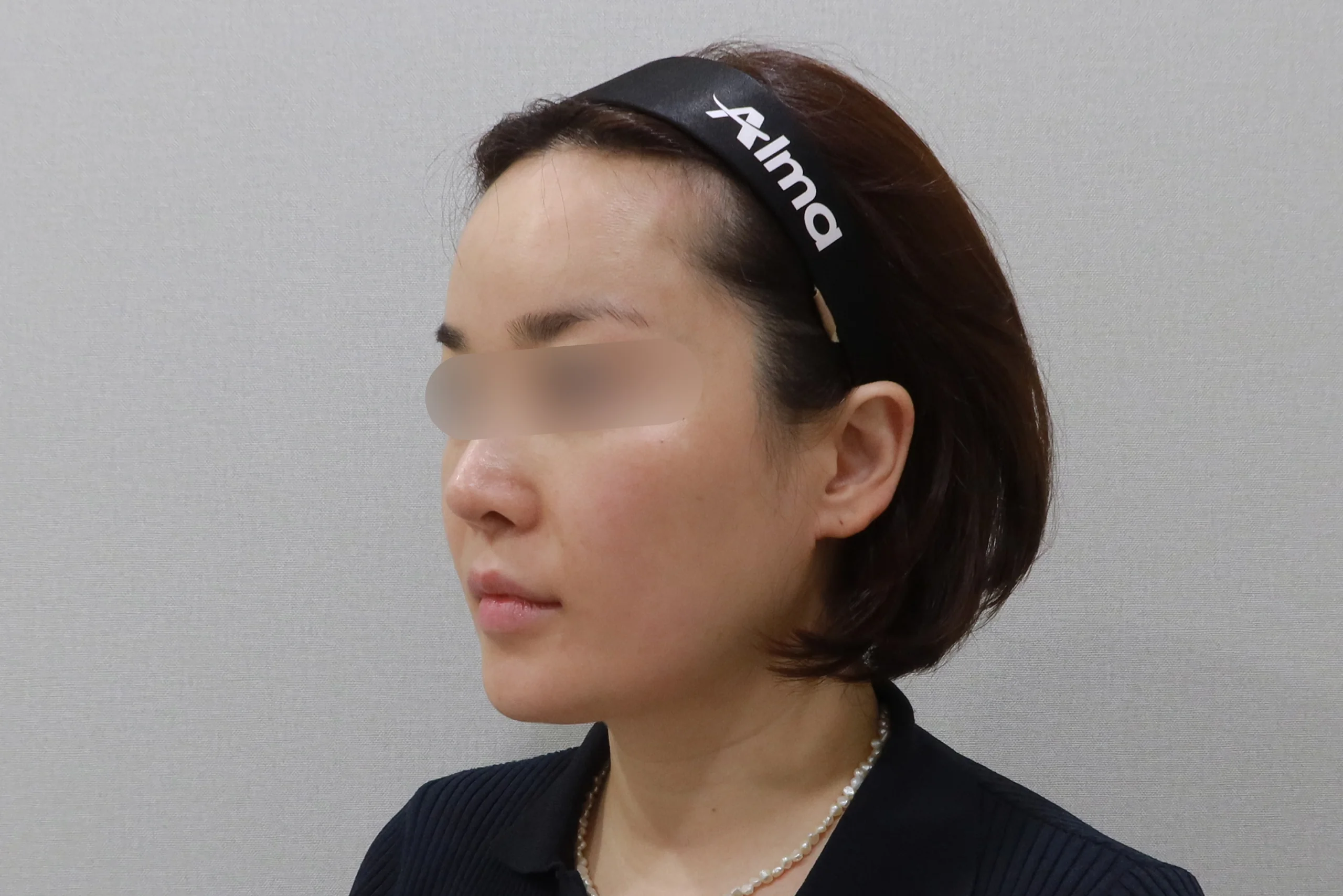 注射面部橡皮膏后的侧视图 4