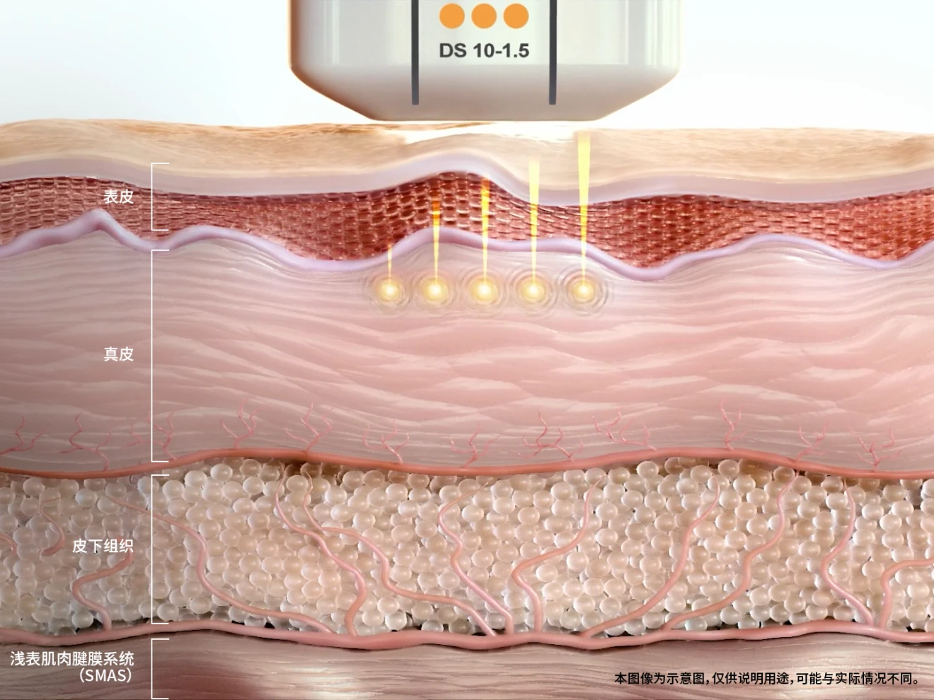 Ultherapy PRIME 1.5mm探头真皮浅层作用剖面图