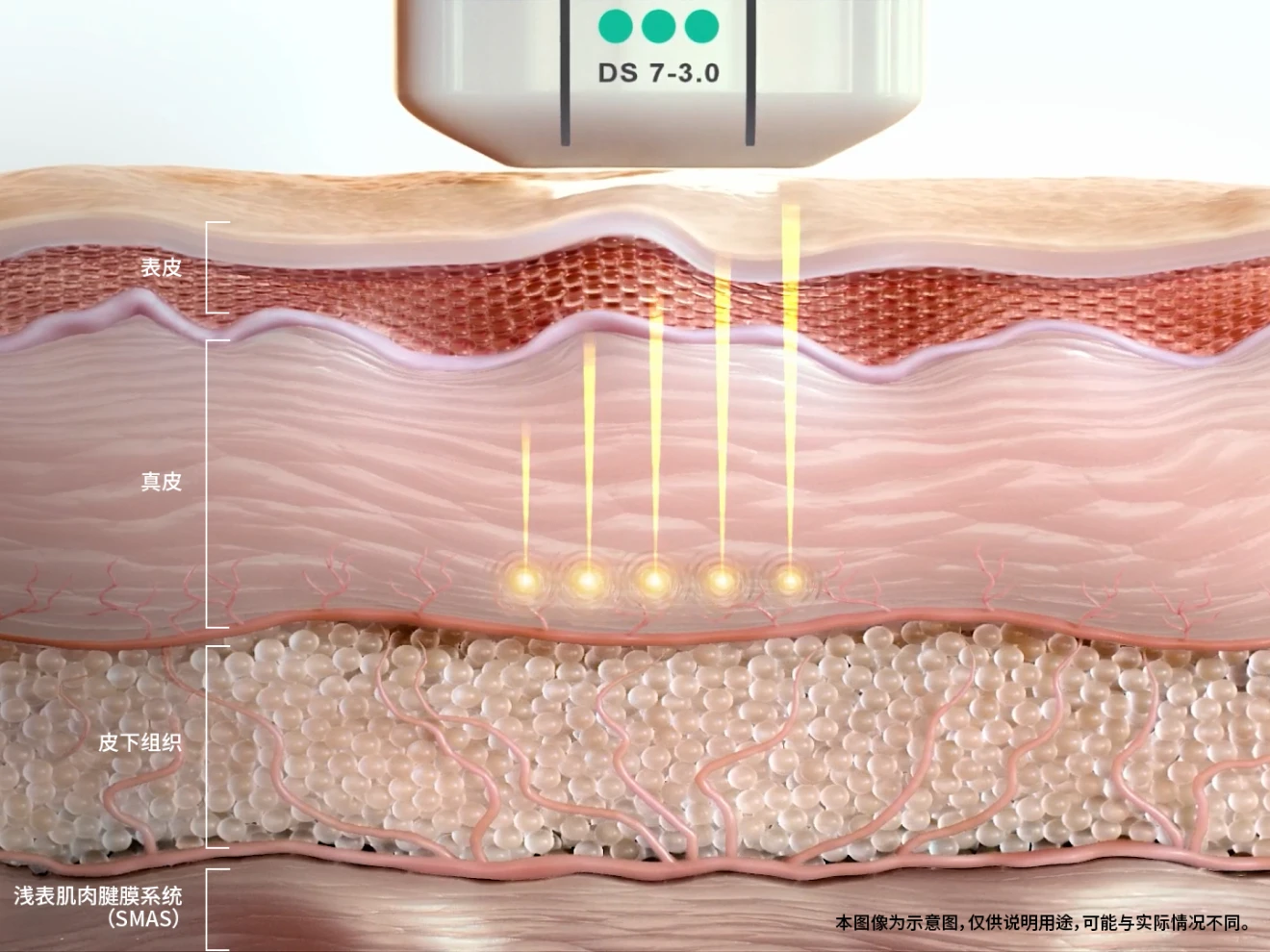 Ultherapy PRIME 3.0mm探头真皮深层作用剖面图