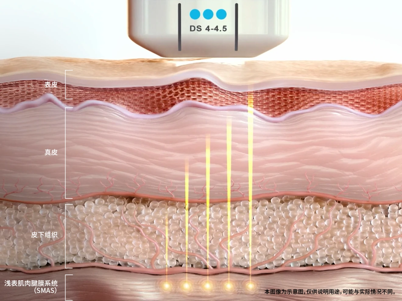 Ultherapy PRIME 4.5mm探头SMAS筋膜层作用剖面图
